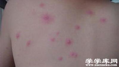 感染水痘幾天能好 水痘的癥狀和治療